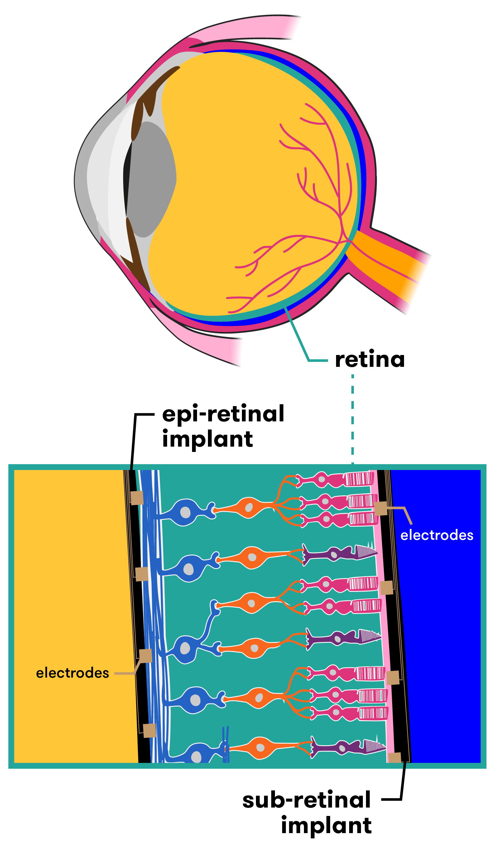 Epiretinal implants are placed in front of the retina; subretinal implants are placed at the back.