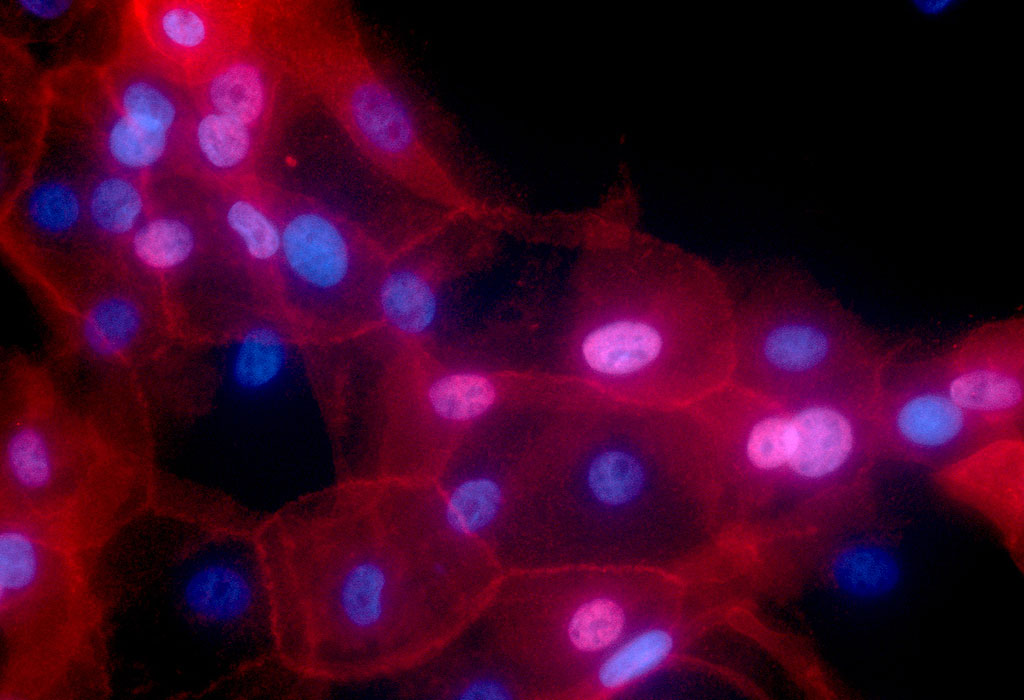 Breast cancer cells with features like the cell nucleus highlighted by fluorescence.
