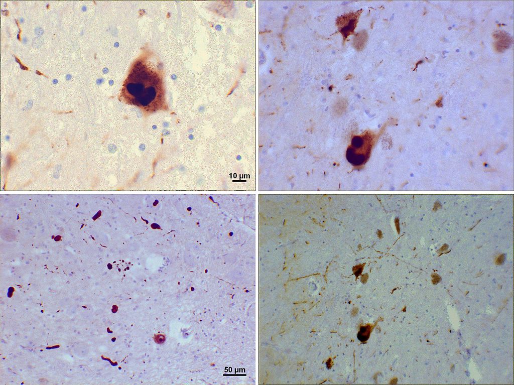 Photomicrograph of regions of substantia nigra in a Parkinson's patient showing Lewy bodies and Lewy neurites in various magnifications.