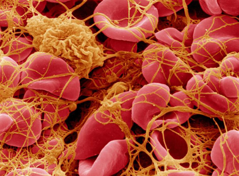 A colourised scanning electron micrograph image of a blood clot. There are red blood cells and other cell shapes held together with a fibrous web-like mesh.