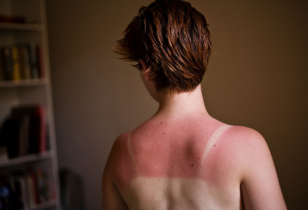 Person with burn marks on back from too much sun
