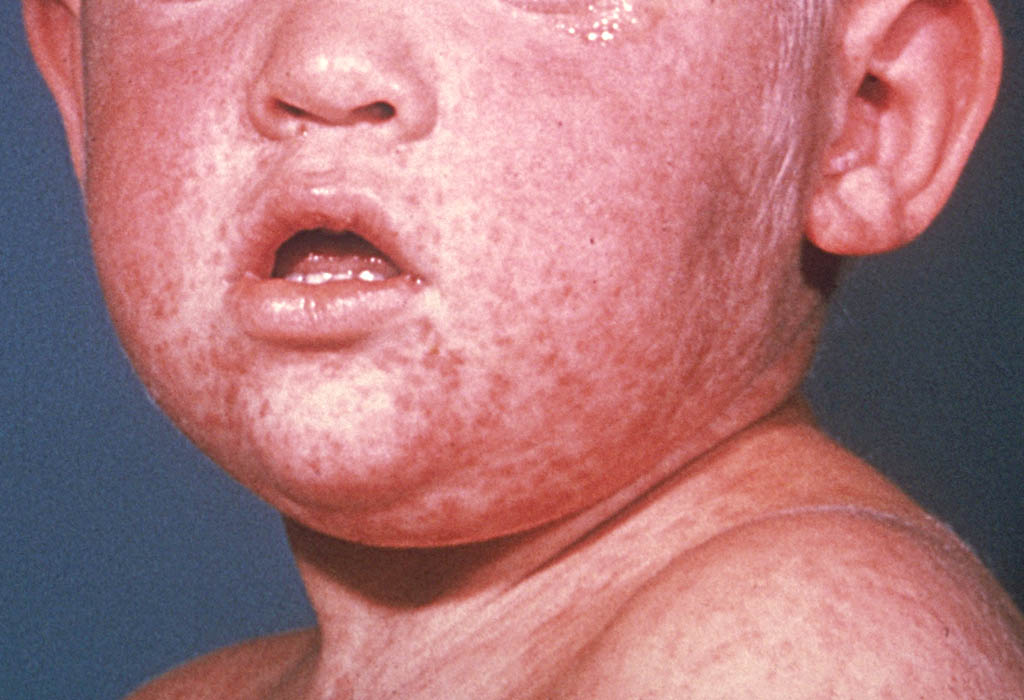 Close-up of young child showing characteristic spotty rash