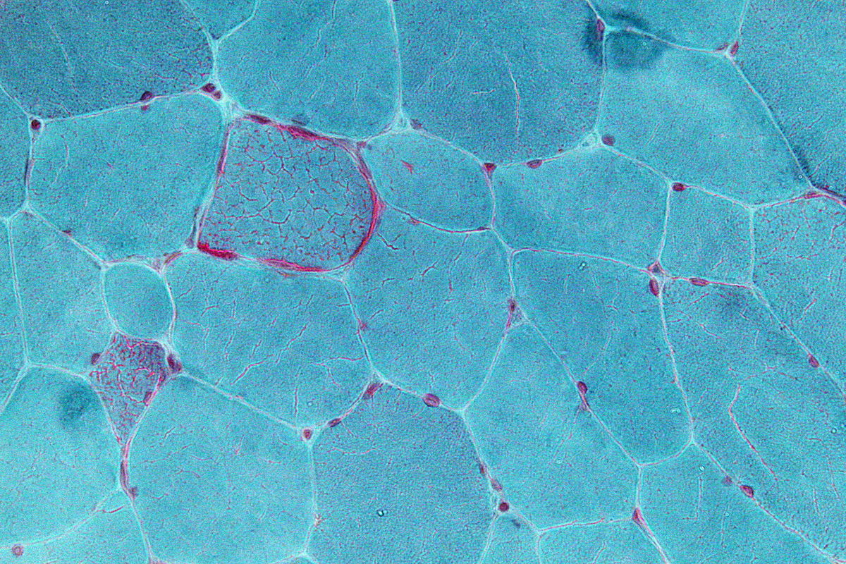 A micrograph showing ragged red fibres, a classic diagnostic marker (sign) of mitochondrial disease.