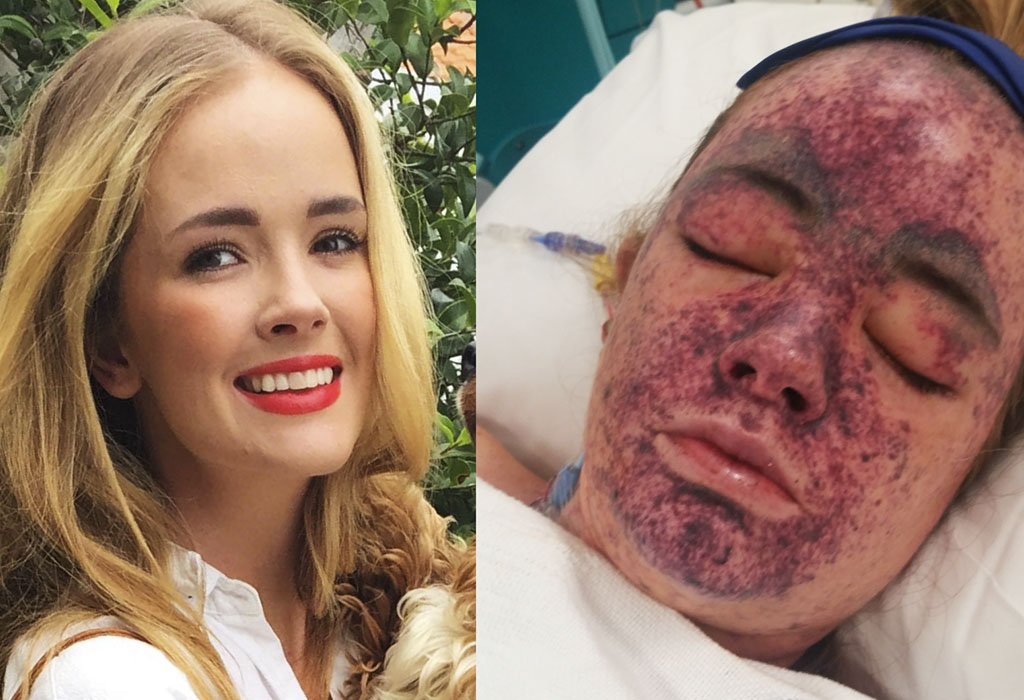 Two photos showing a healthy young person (left) and the same person with a blotchy purple rash covering their face