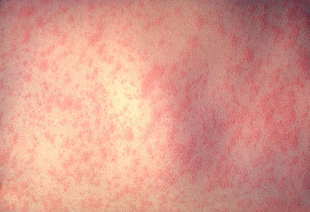 The characteristic blotchy rash of measles