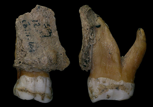 Neanderthal teeth with dental calculus deposits