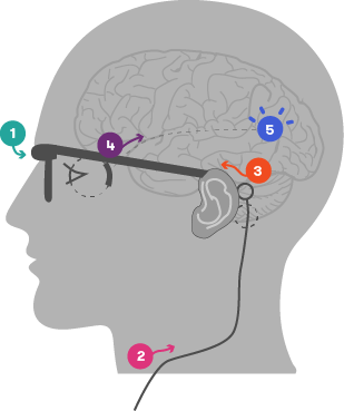 How the bionic eye works, steps described below. Camera is placed in front of the eyes; external wire connects to the implanted system near the ear; retinal implant and its electrode array is at the back of the eye; vision processing centres of the brain are near the back of the head.