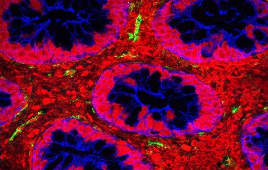 Bacterial toxin in the intestine of a child