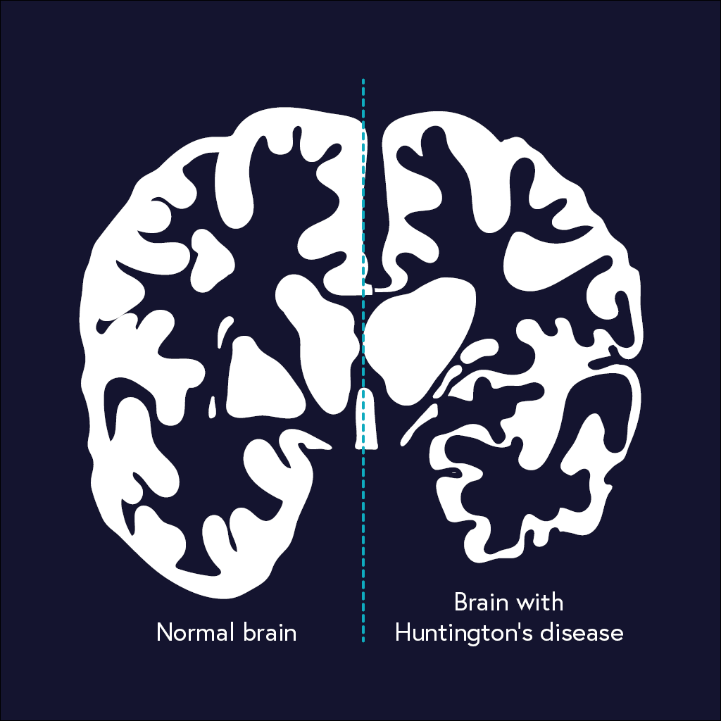 Infographic showing structural comparison between a normal healthy brain and a brain affected by Huntington's disease