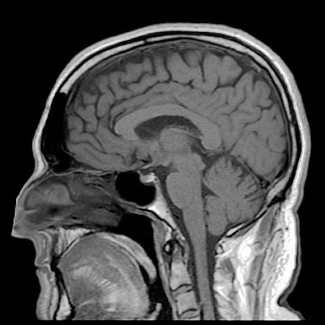 Brain scan using MRI technology 